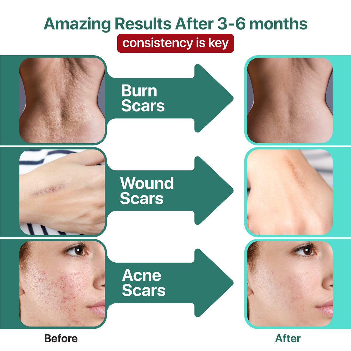 Ebanel Bundle of Advanced Silicone Scar Gel 1 Oz, and Hyaluronic Acid Serum